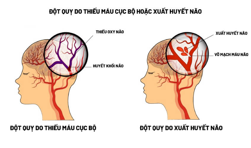 Tai Biến Mạch Máu Não